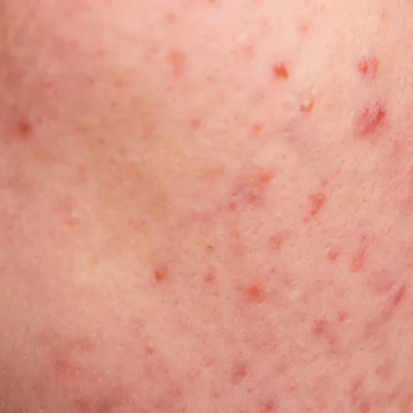 Acne